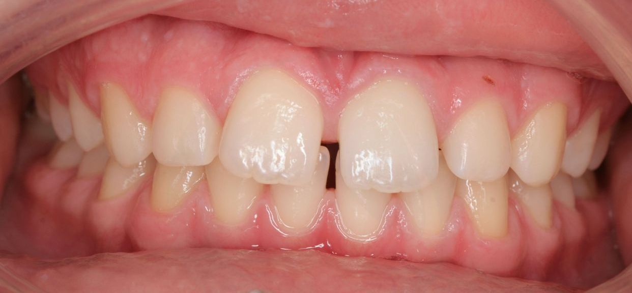 Clear aligner treatment — before