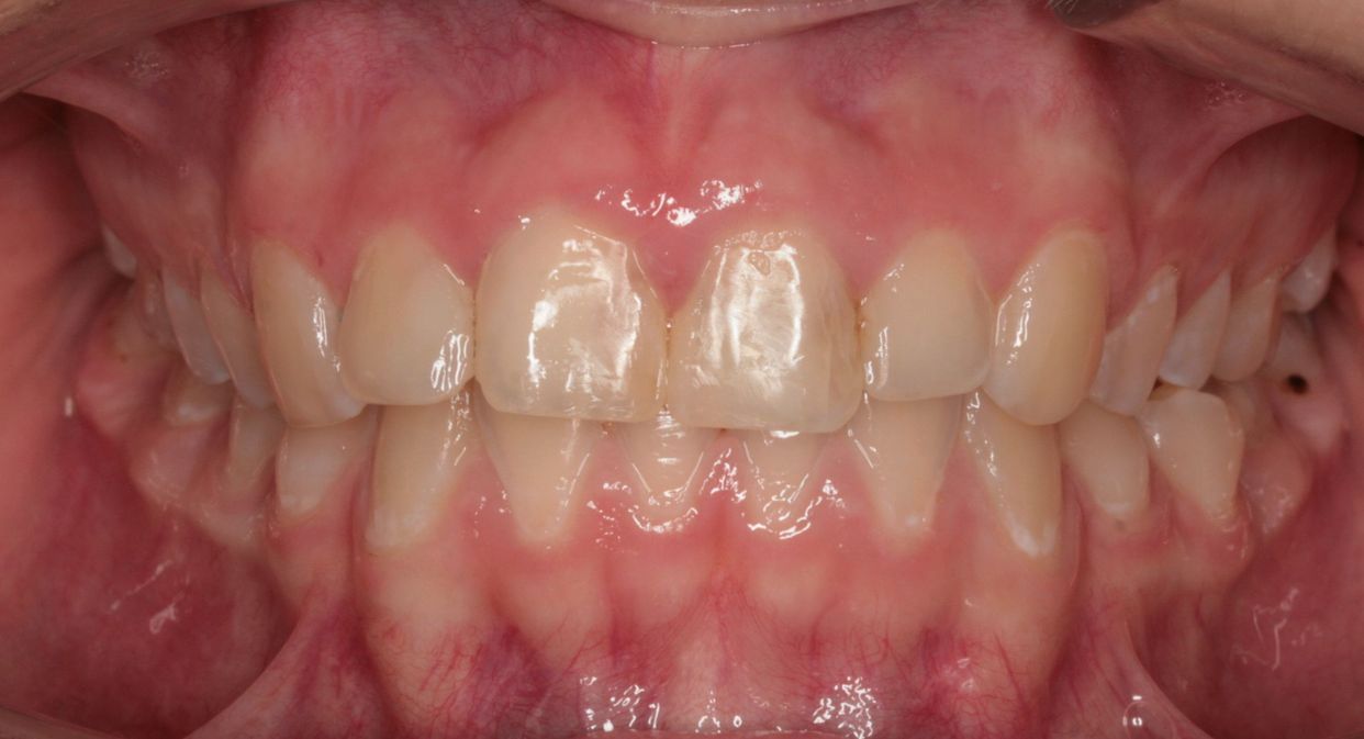 Clear aligner treatment — after