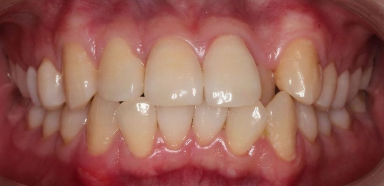 Clear aligner treatment — before