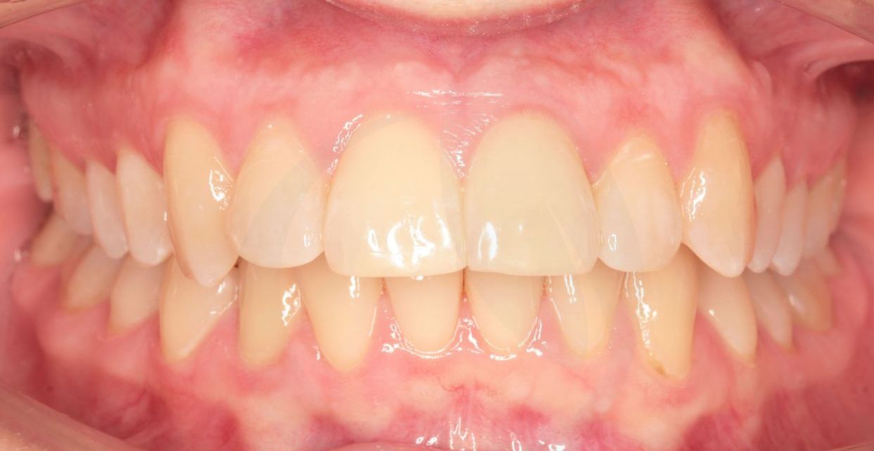 Clear aligner treatment — after
