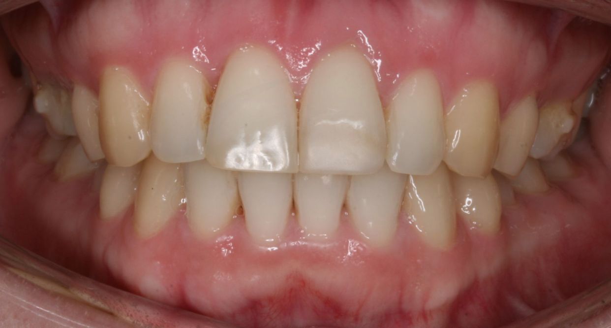 Clear aligner treatment — after