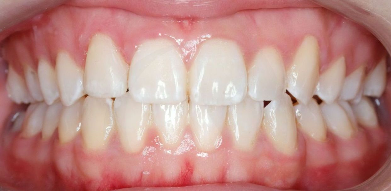 Clear aligner treatment — after
