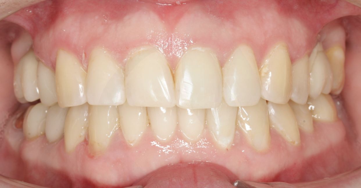 Clear aligner treatment — after