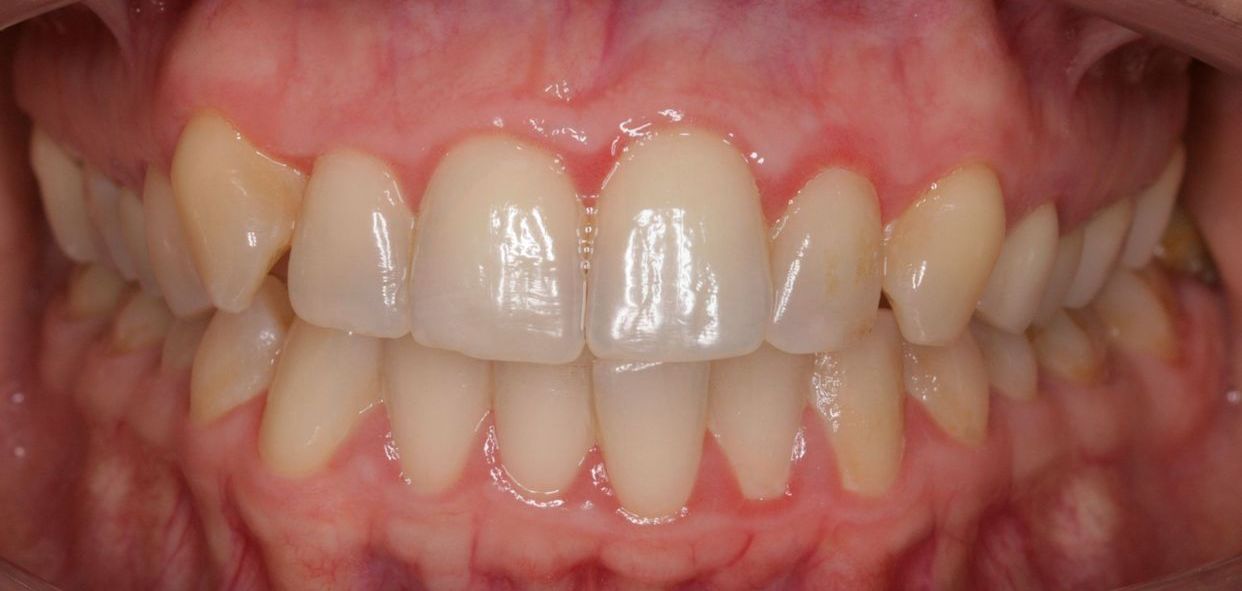 Clear aligner treatment — before