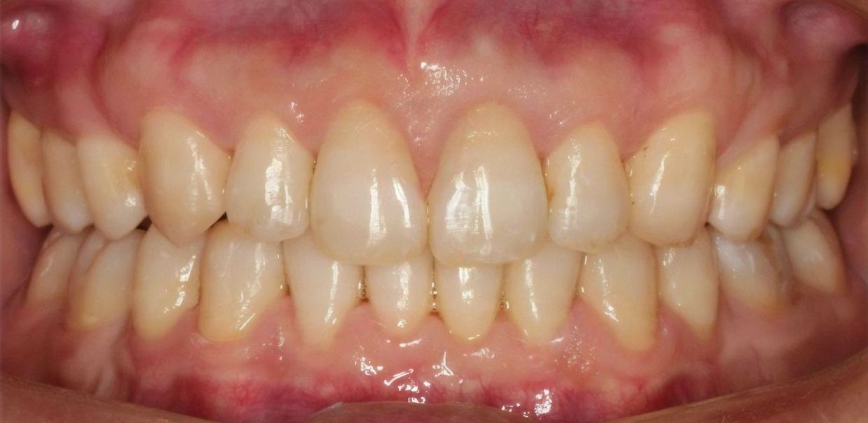 Clear aligner treatment — after