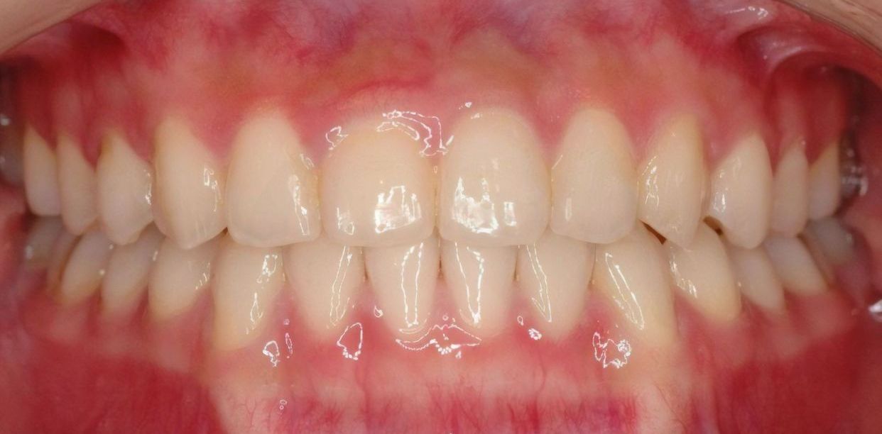 Clear aligner treatment — after