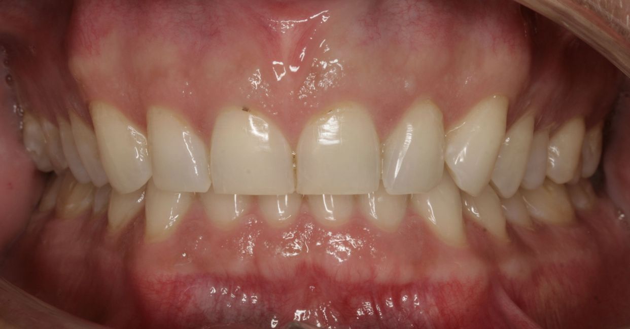 Clear aligner treatment — after