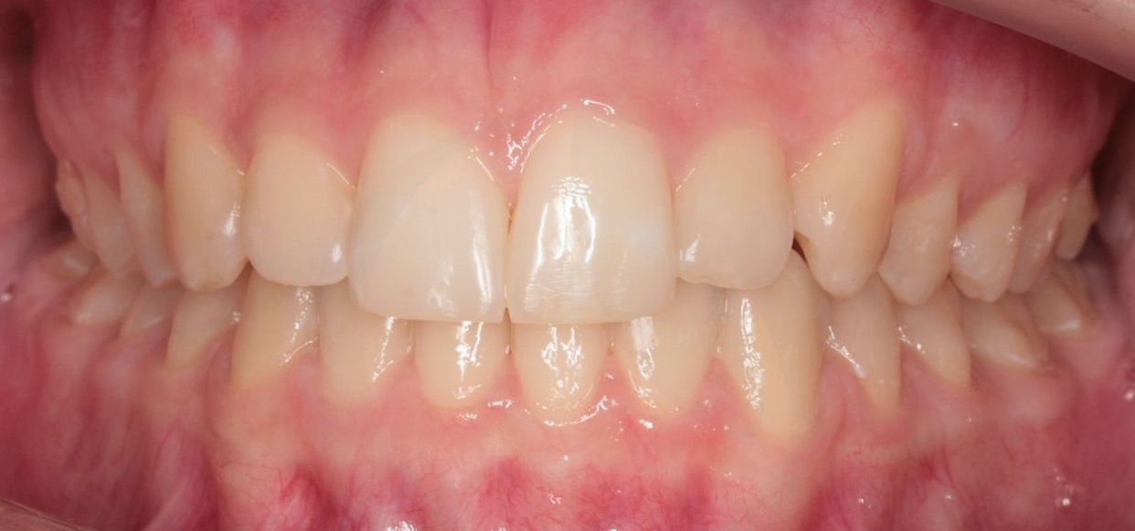 Clear aligner treatment — after