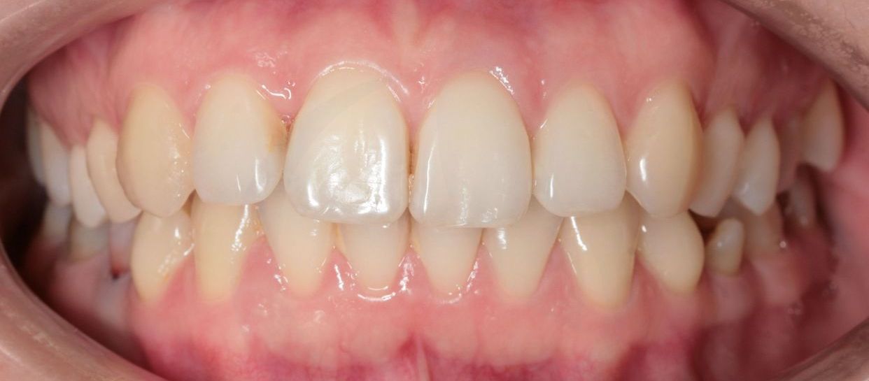 Clear aligner treatment — after