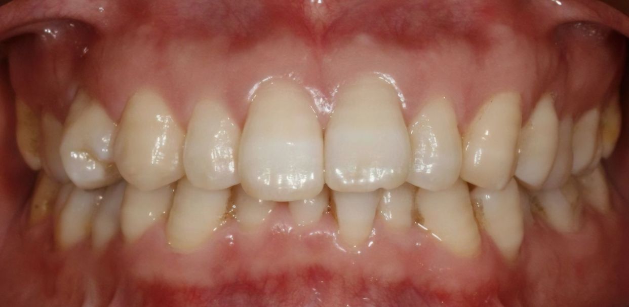 Clear aligner treatment — before