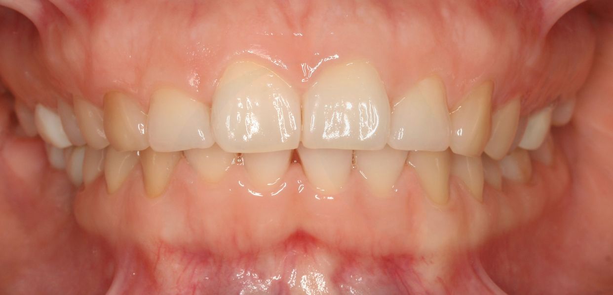 Clear aligner treatment — after