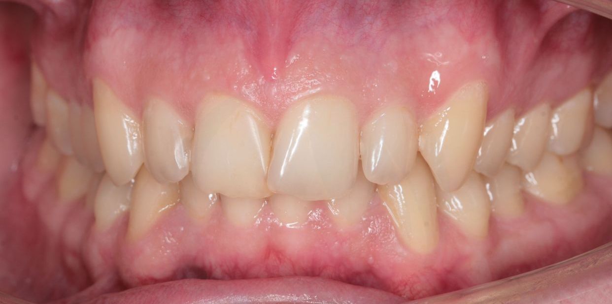Clear aligner treatment — before