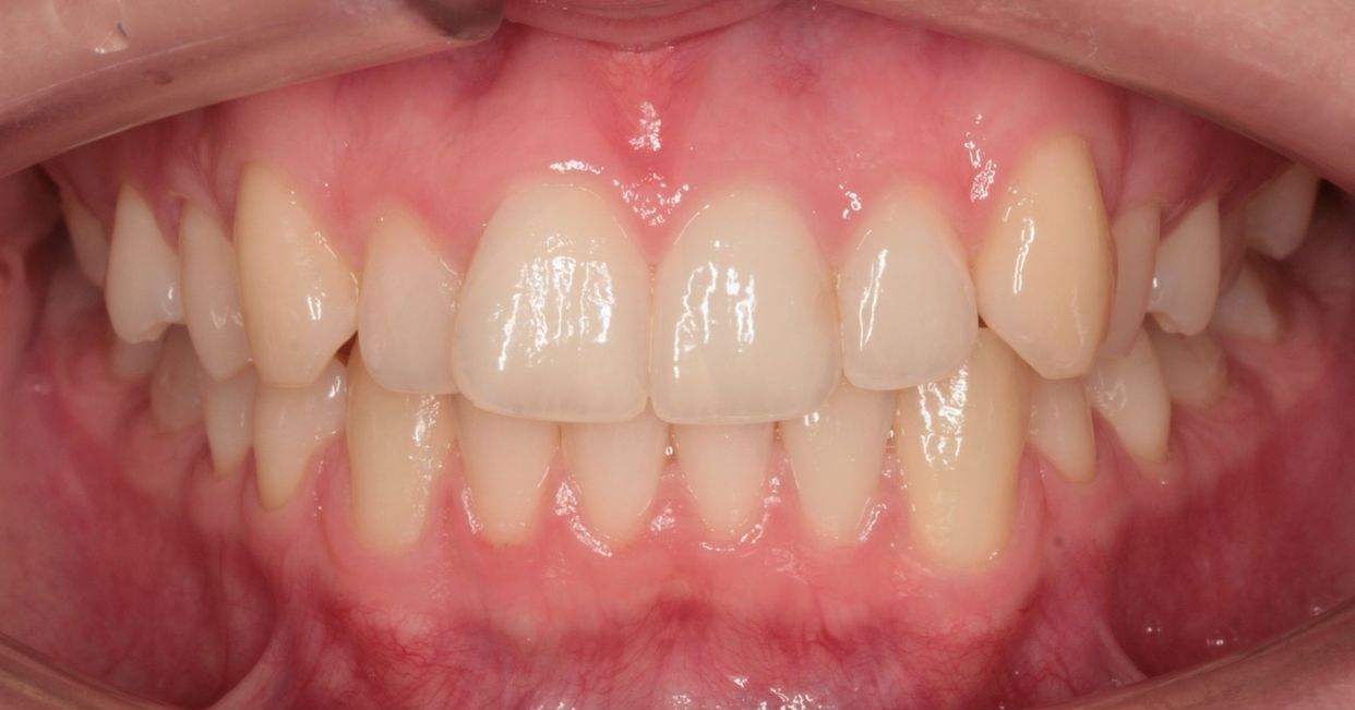 Clear aligner treatment — before