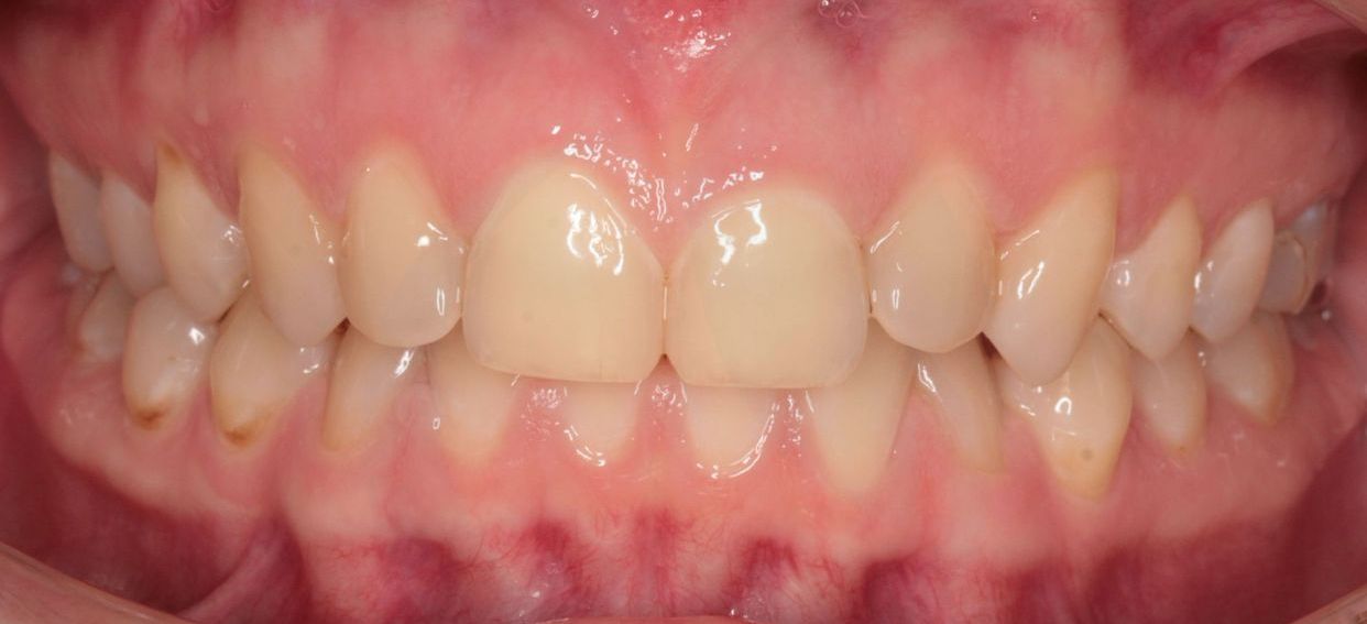 Clear aligner treatment — after