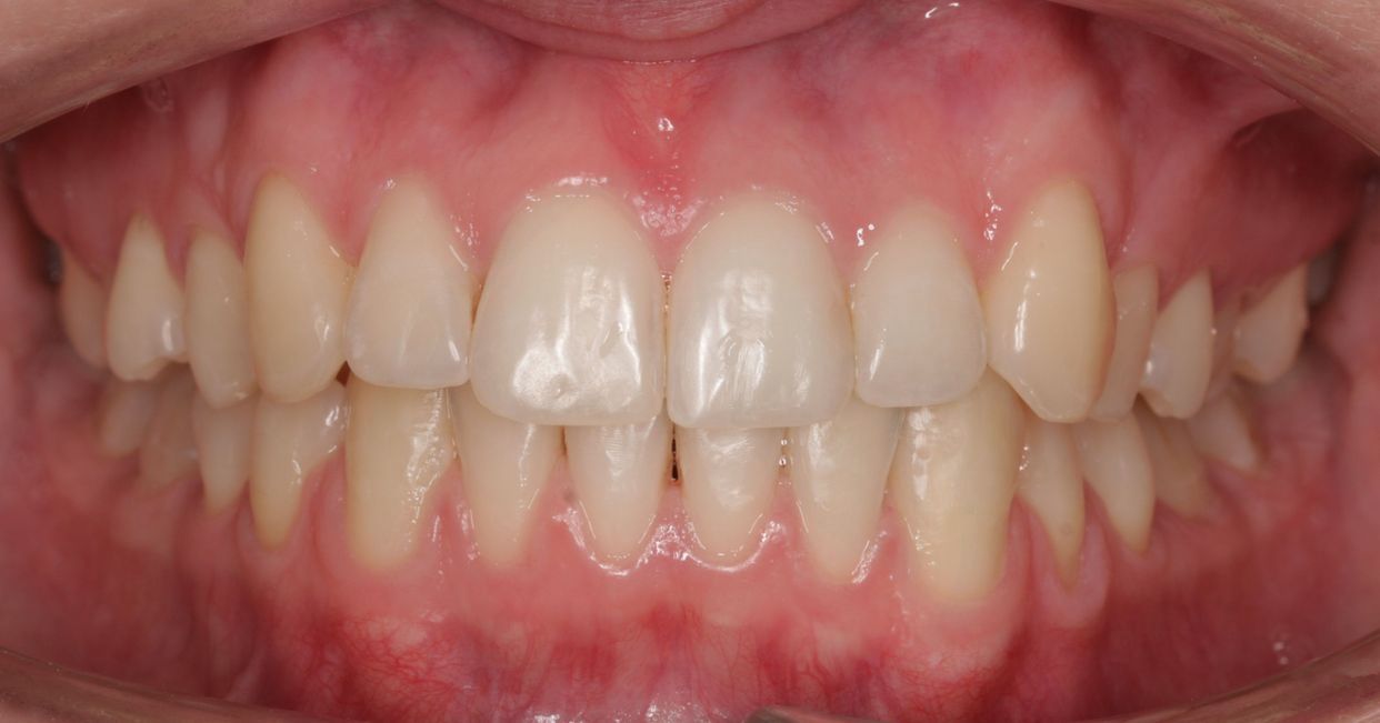 Clear aligner treatment — after