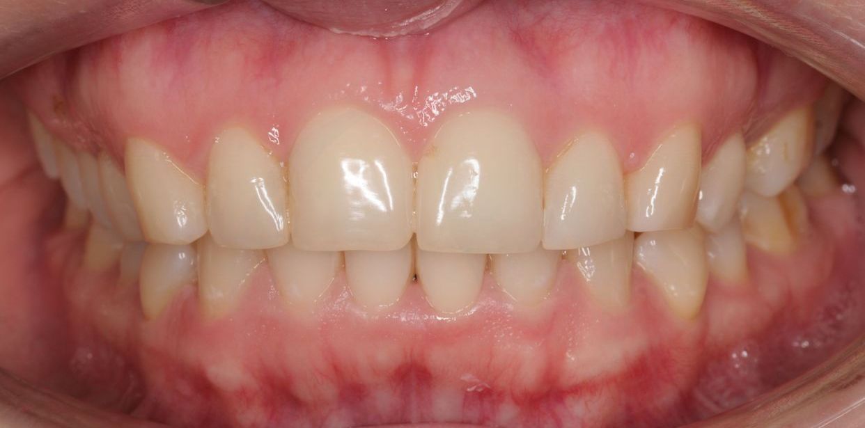 Clear aligner treatment — after