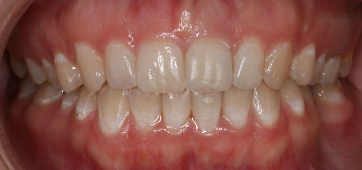 Clear aligner treatment — after