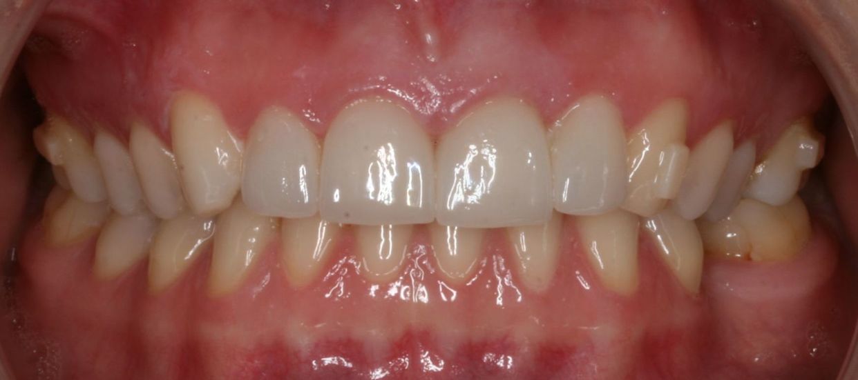 Clear aligner treatment — after