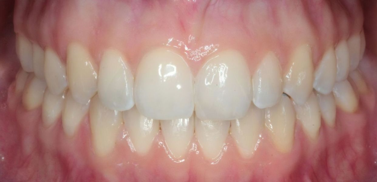 Clear aligner treatment — after