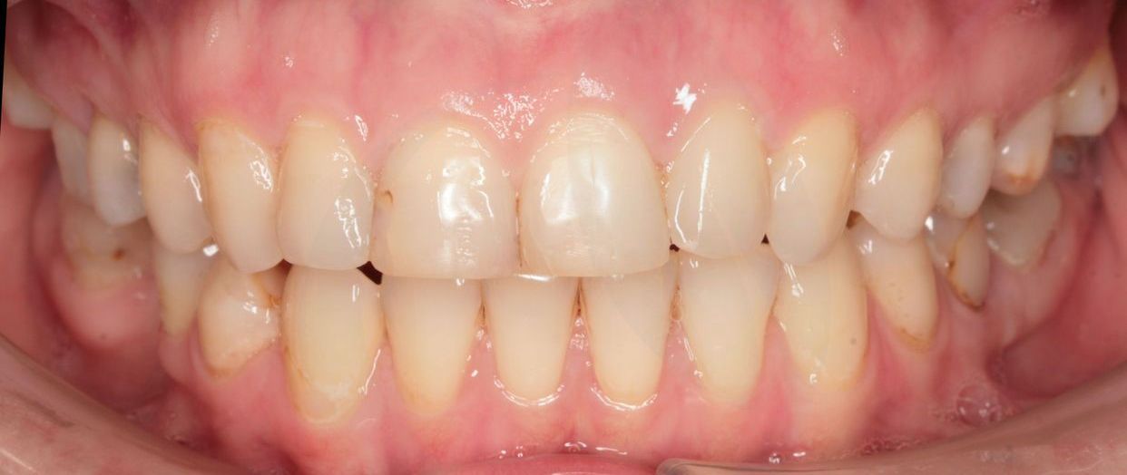 Clear aligner treatment — after