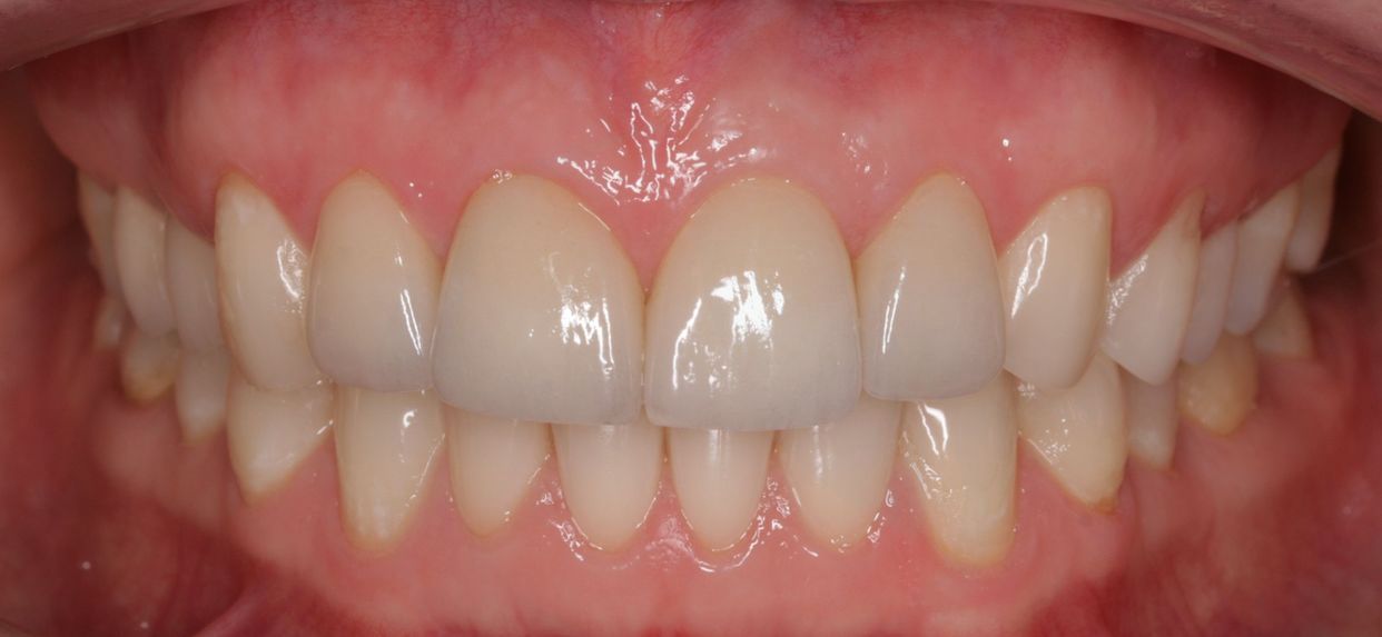 Clear aligner treatment — after
