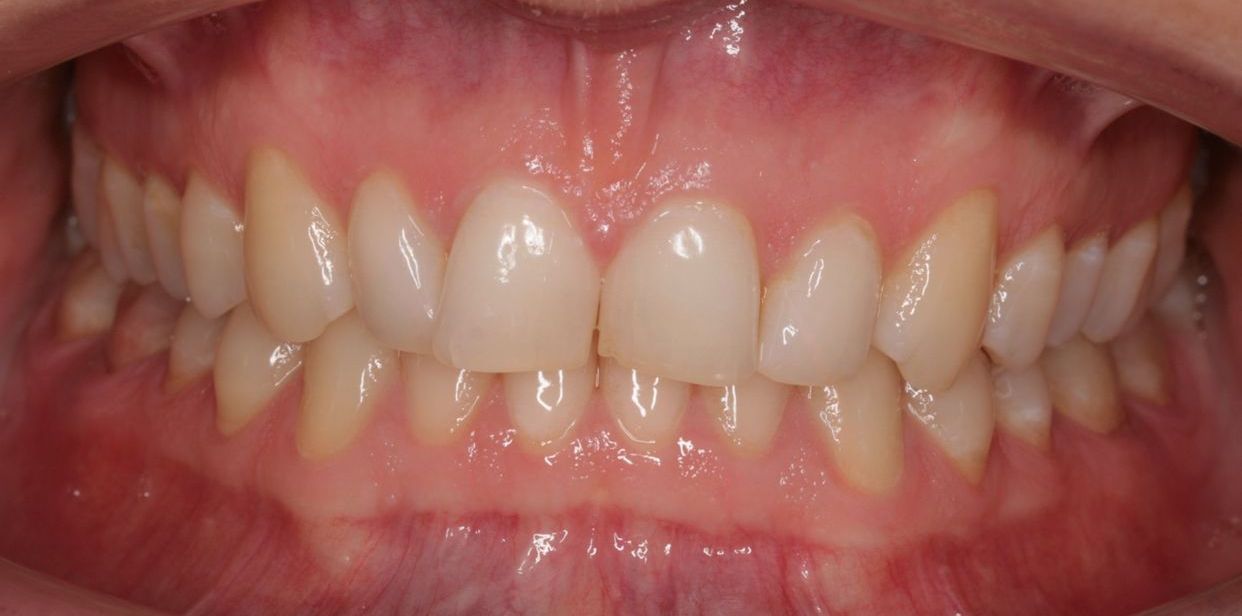 Clear aligner treatment — before