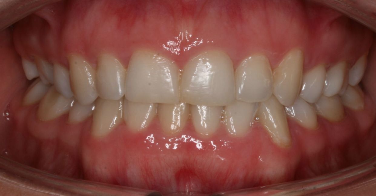 Clear aligner treatment — after