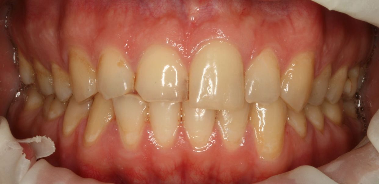 Clear aligner treatment — before