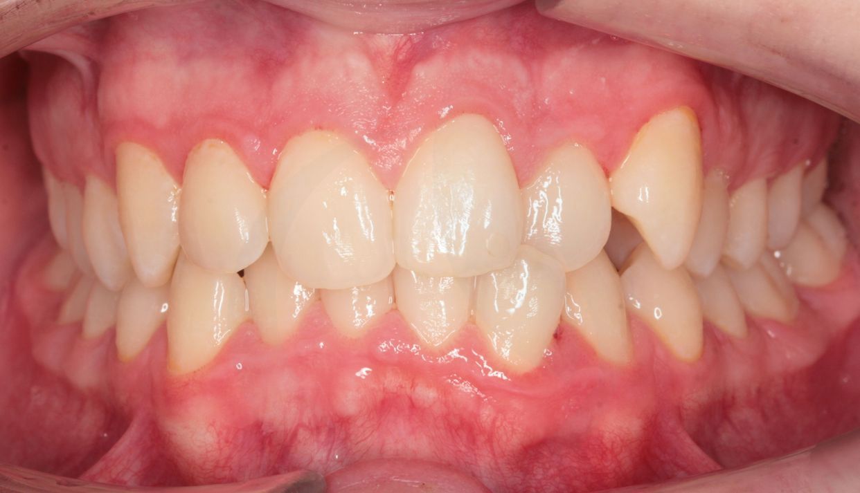 Clear aligner treatment — before