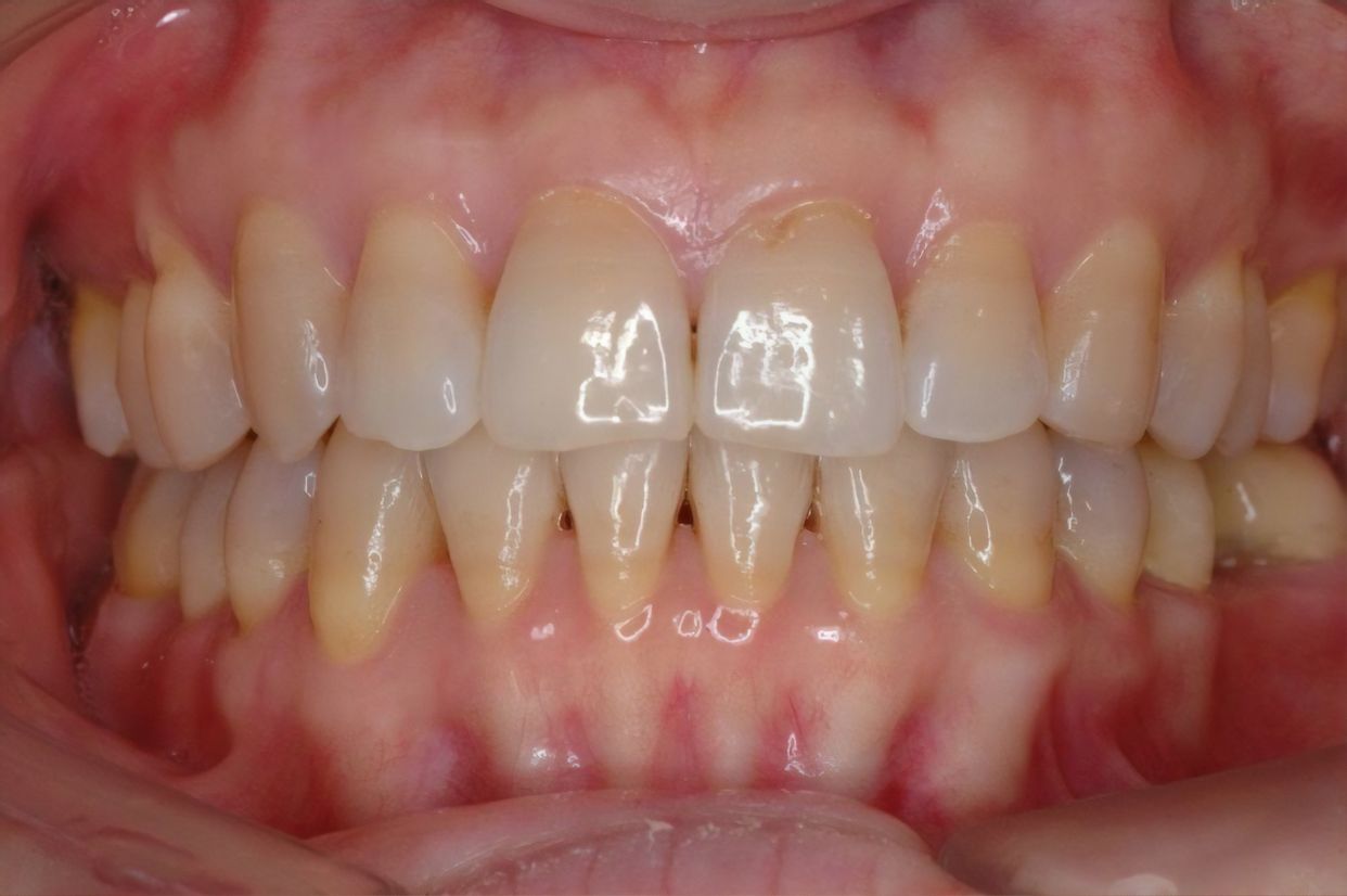 Clear aligner treatment — after