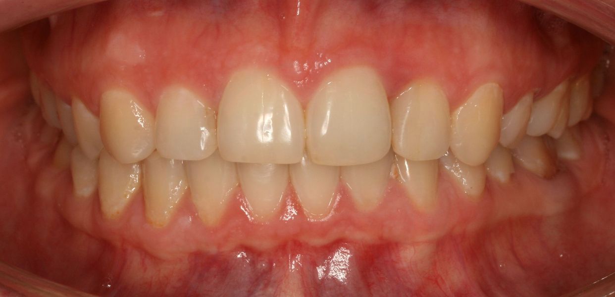 Clear aligner treatment — after