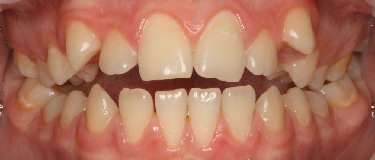 Clear aligner treatment — before