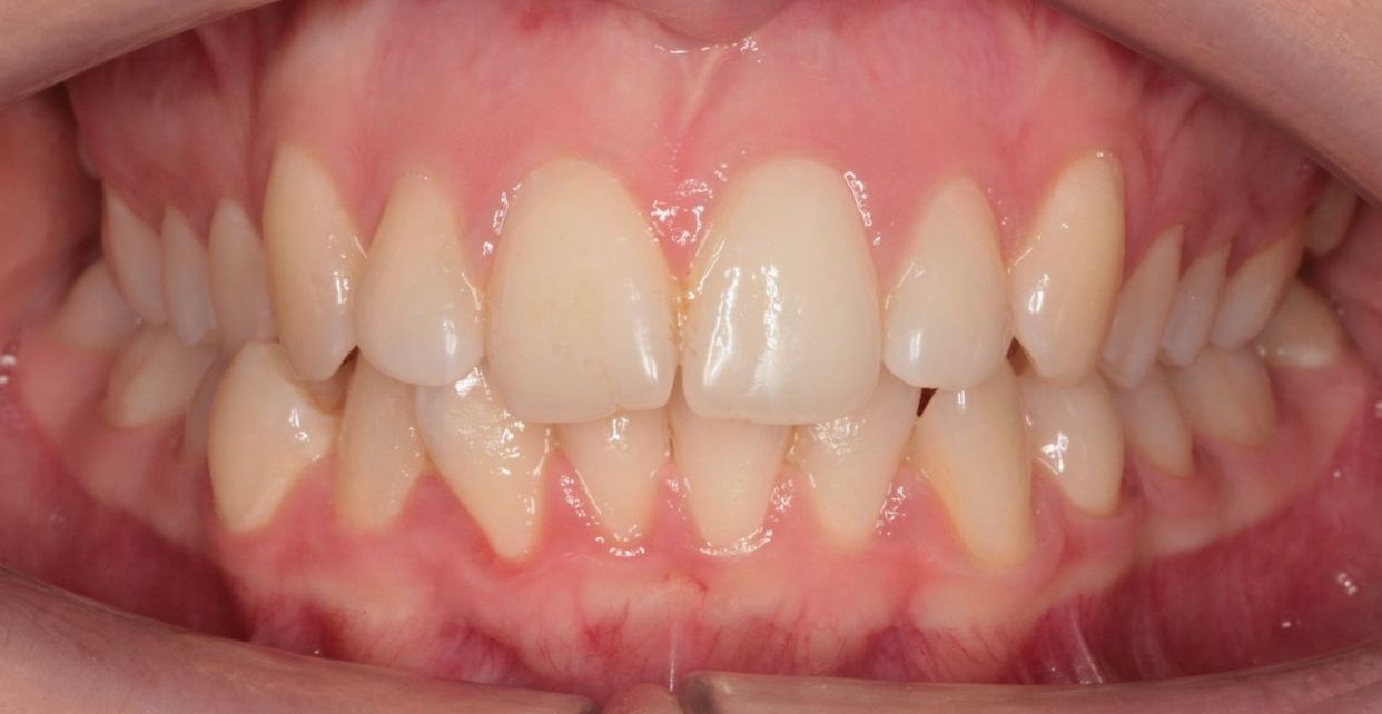 Clear aligner treatment — before
