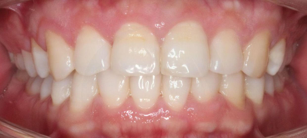 Clear aligner treatment — after