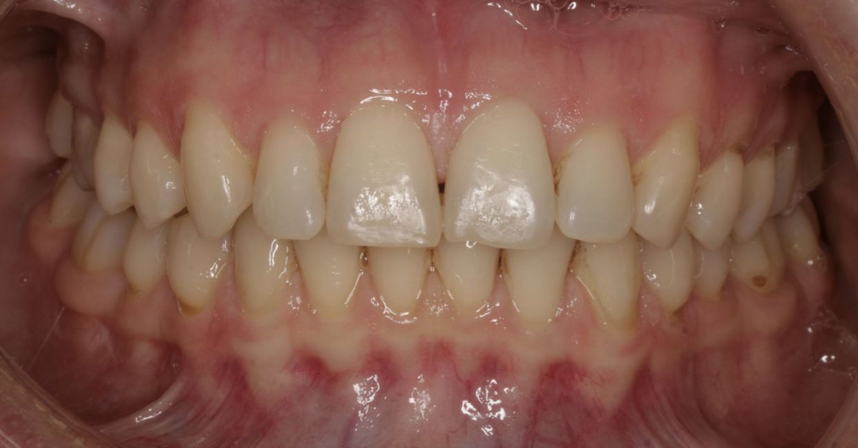 Clear aligner treatment — after