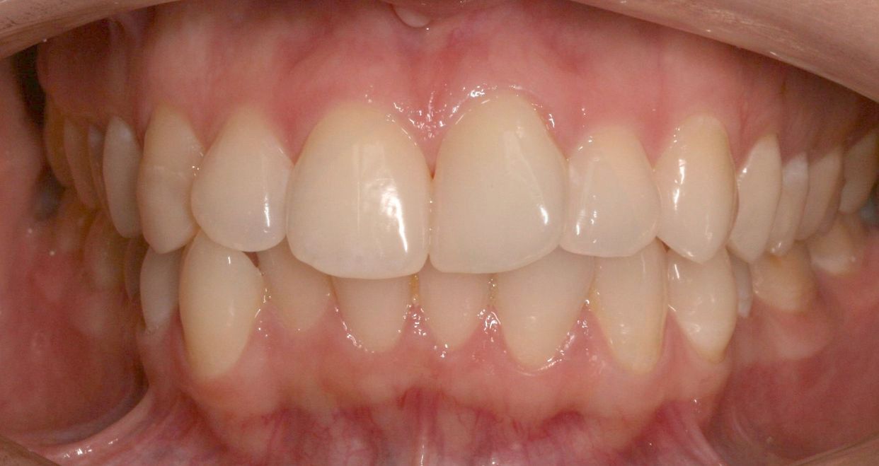 Clear aligner treatment — before