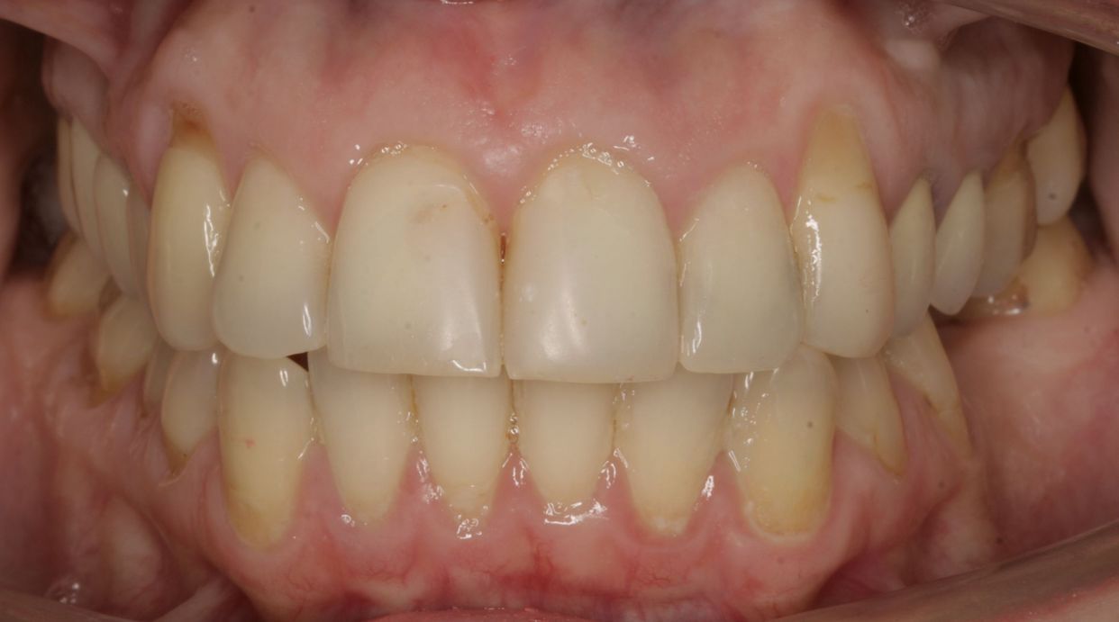 Clear aligner treatment — after