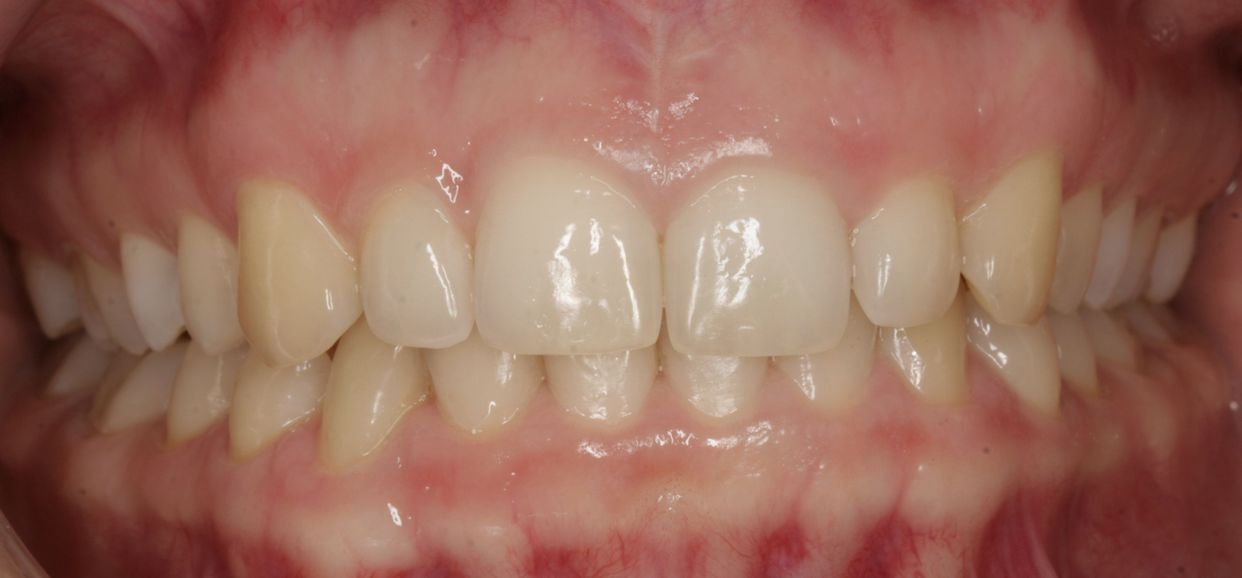 Clear aligner treatment — after