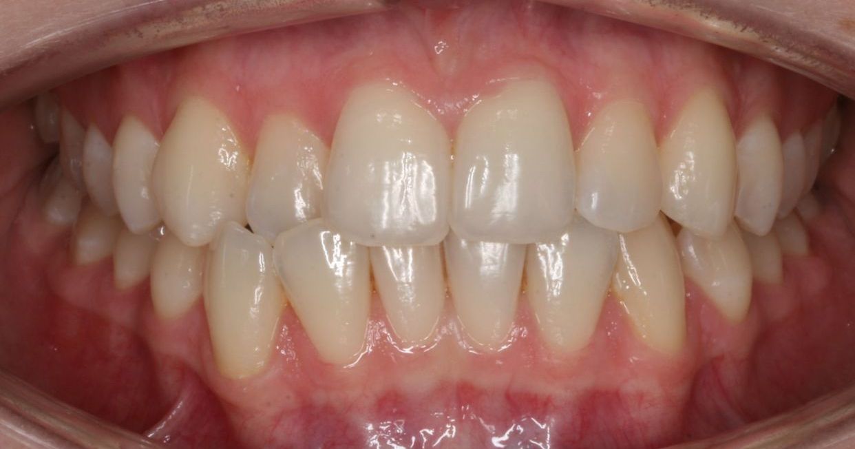 Clear aligner treatment — before