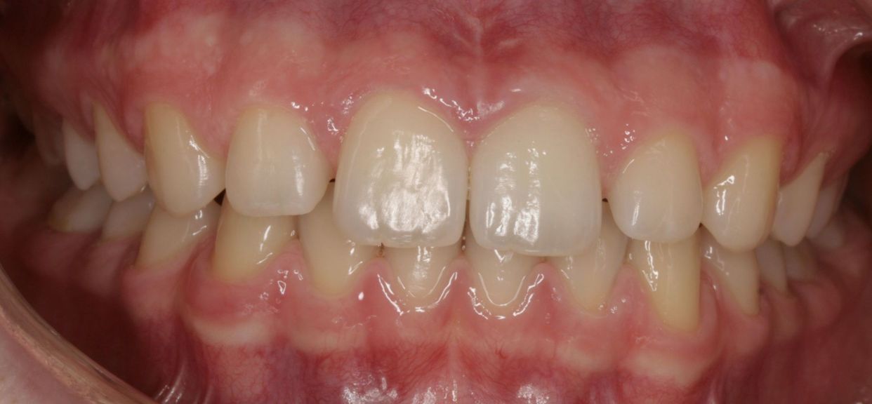 Clear aligner treatment — after