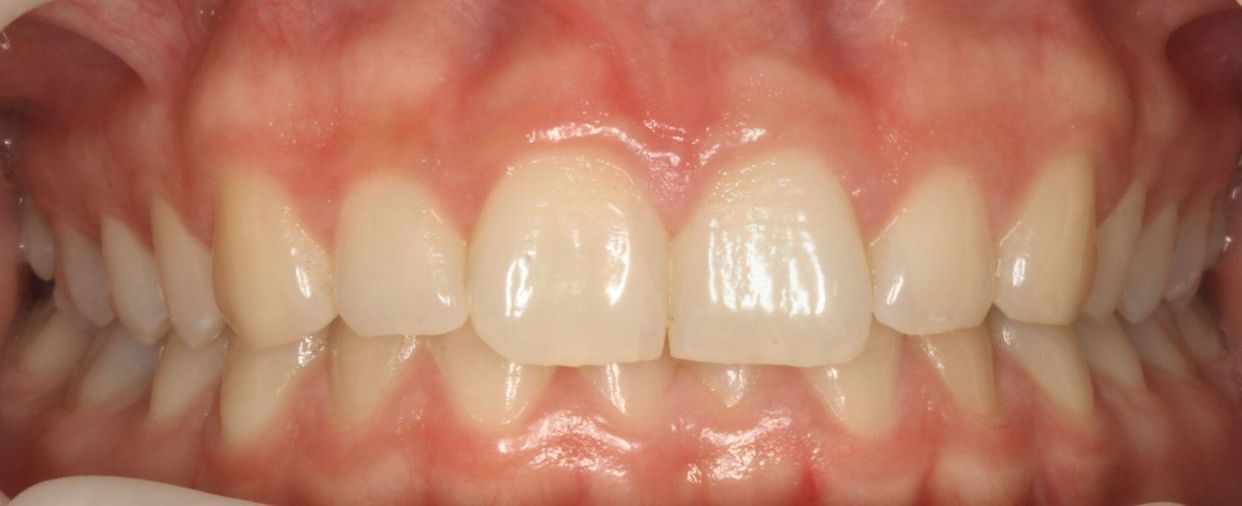 Clear aligner treatment — before