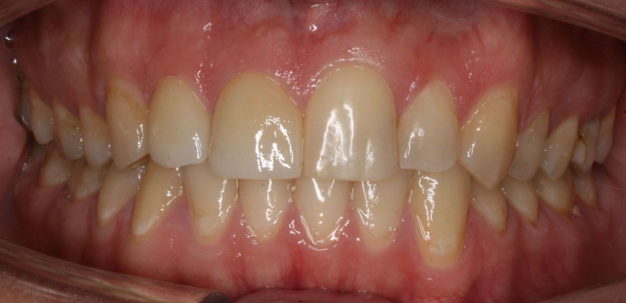 Clear aligner treatment — after
