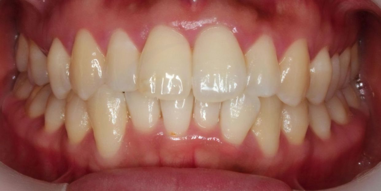 Clear aligner treatment — before
