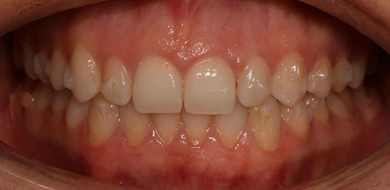 Clear aligner treatment — before