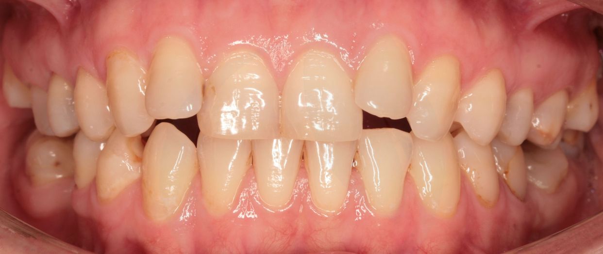 Clear aligner treatment — before