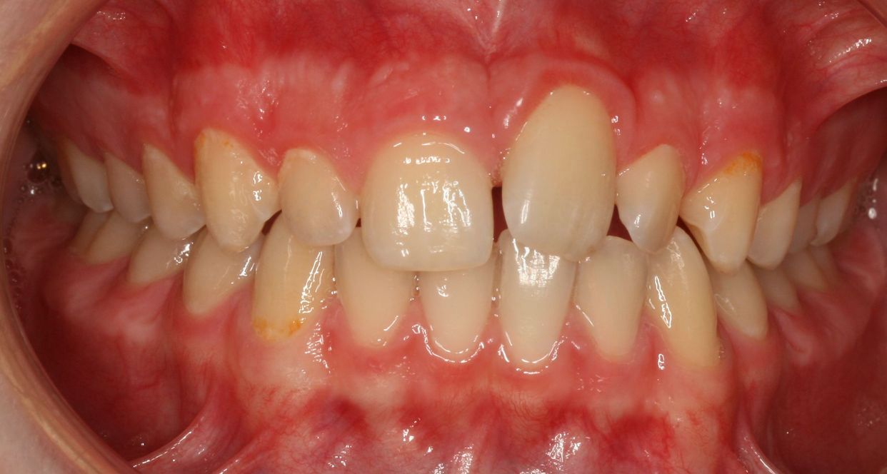 Clear aligner treatment — before