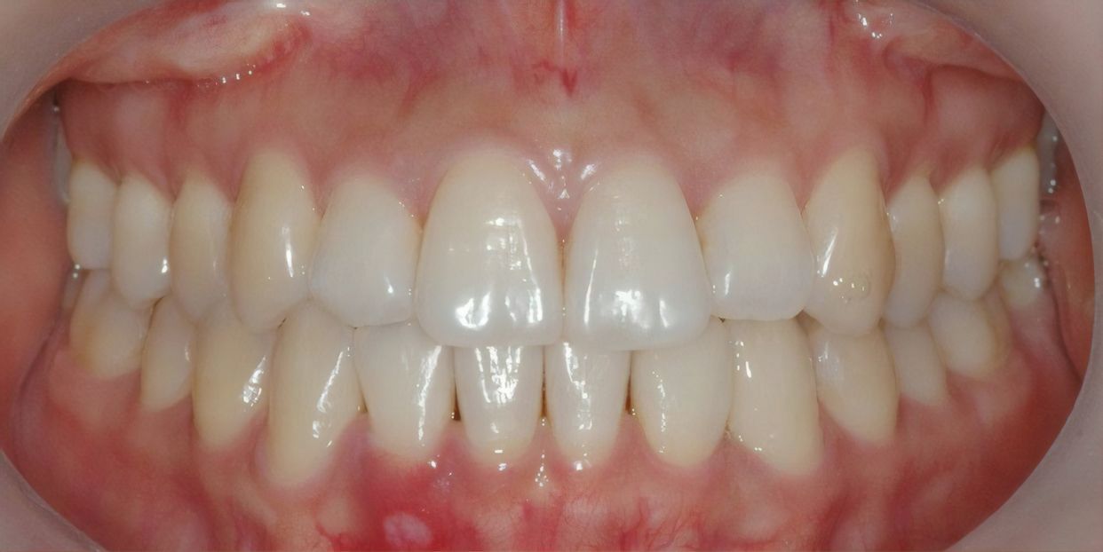 Clear aligner treatment — after