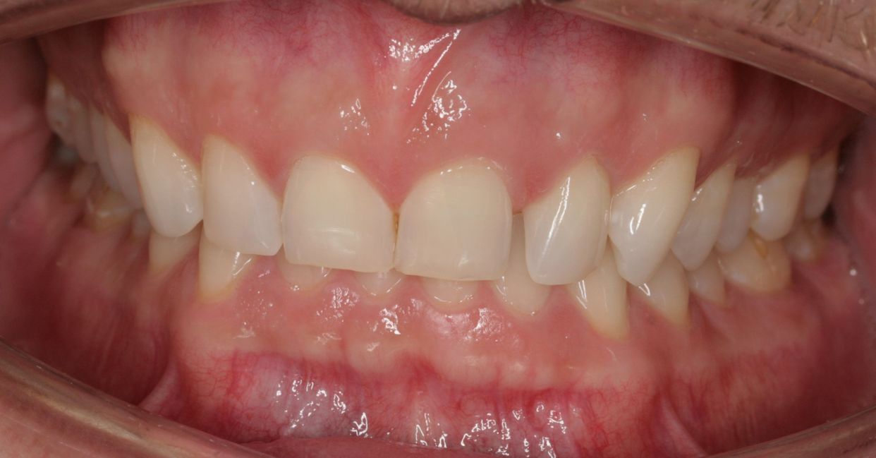 Clear aligner treatment — before