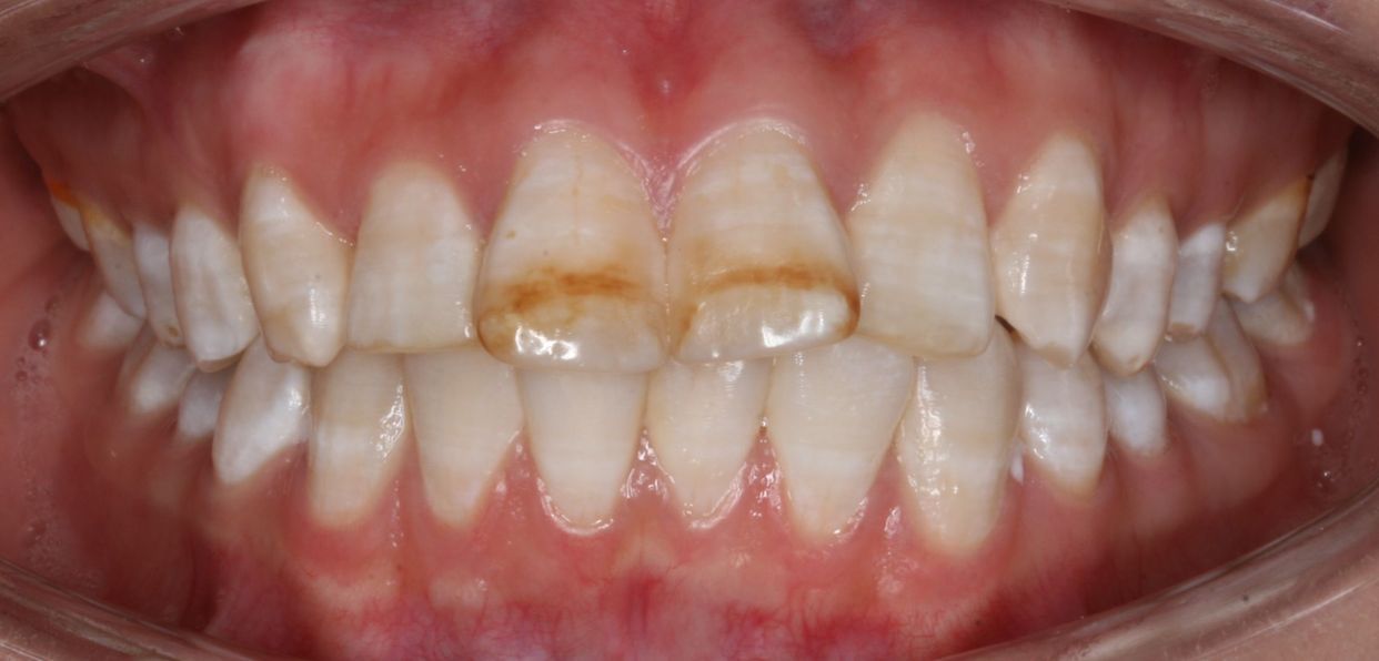 Clear aligner treatment — before