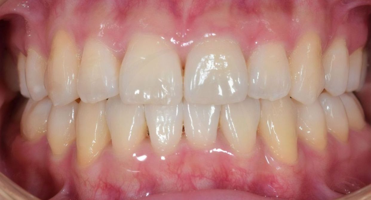 Clear aligner treatment — after
